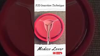 IUD or IUCD is inserted inside the womb [upl. by Nessah]