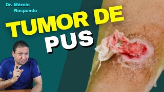 ABSCESSO tumor de pus pode dar febre após drenagem  Dr Márcio Responde [upl. by Rustin]