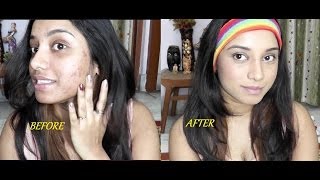 Severe acne coverage foundation routine for Indian skin tone [upl. by Arral198]