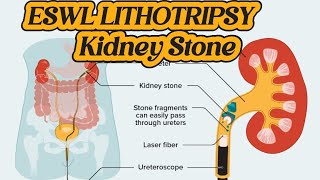 How to do Operation of Lithotripsy  ESWL Lithotripsy  Kidney Stone Treatment  Renal DJ Stent [upl. by Carolan]