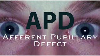 How to detect an APD Afferent Pupillary Defect [upl. by Ellimaj]