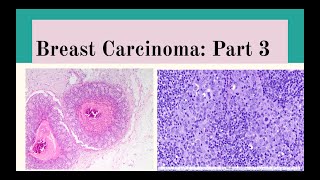 Breast Carcinoma Part 3 [upl. by Assilen610]