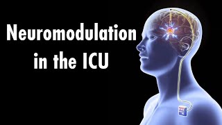 Neuromodulation in the intensive care unit [upl. by Eitra]