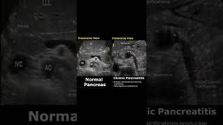 Chronic Pancreatitis Ultrasound  Pancreas Normal Vs Abnormal USG shorts  ultrasound  radiology [upl. by Idelle]