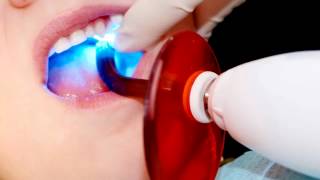 What are Dental Sealants [upl. by Dielle]