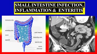 SMALL INTESTINE INFECTION INFLAMMATION amp ENTERITIS  Define  causes  types signs  diagnostic [upl. by Varden]