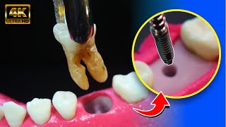 FASINANTE proceso del IMPLANTE dental en 4K [upl. by Wayne673]