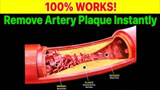 6 Secret Vitamins to Instantly Remove Artery Plaque [upl. by Noisla]