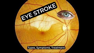 Eye Stroke Types Symptoms and Treatment Retinal Vein Occlusion [upl. by Deehsar304]