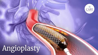 How is Angioplasty Done  Radial Access Procedure  PostTreatment Care After Angioplasty [upl. by Prissy]