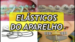 Tipos de ELÁSTICOS do Aparelho Ortodôntico  FUNÇÕES DE CADA UM DELES [upl. by Ennovad]