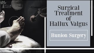 Bunion surgery  surgical treatment of hallux valgus [upl. by Nosde989]