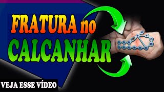 FRATURA NO CALCANHAR RECUPERAÇÃO PARTE 1 [upl. by Ursulette]