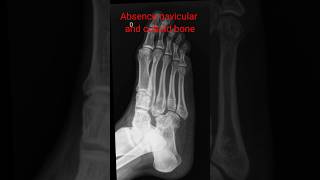 Absence of tarsal bones navicular and cuboid bone shorts footxray [upl. by Kelli]