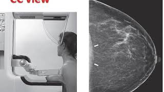 week 21 breast imaging [upl. by Ettedranreb319]