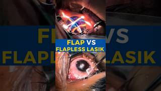 Flap VS Flapless Lasik [upl. by Charmaine]