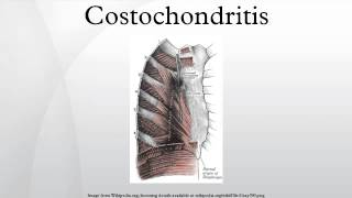 Costochondritis [upl. by Llertnauq]