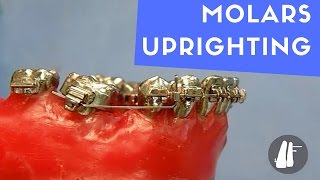 UPRIGHTING MOLARS [upl. by Noeled]