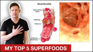 My 5 BEST Foods For Diverticulitis  Diverticulitis Diet Plan [upl. by Yokoyama]