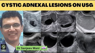 USG Pelvis  Cystic Adnexal Lesions On Ultrasound  SANJEEV MANI  Endometriosis  Ovarian Dermoid [upl. by Soinotna60]