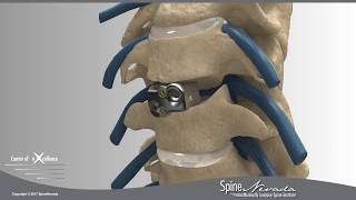 CeresC Standalone ACDF anterior cervical discectomy and fusion MIS procedure [upl. by Bray284]