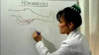 How to Cure Hemorrhoids  What Causes Hemorrhoids [upl. by Juditha]