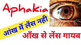 Aphakia क्या हैं । What Is Aphakia। Aphakia क्यों होता हैं।Aphakia का इलाज।youtubernetra Aphakia [upl. by Aicek]