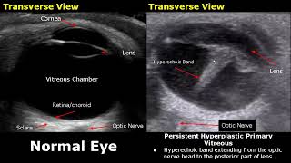 Eye Ultrasound Normal Vs Abnormal Images  CataractRetinal DetachmentGlobe RuptureChoroid USG [upl. by Notserp]