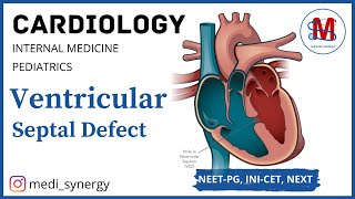 Ventricular Septal Defect  Hemodynamic  Clinical features  Diagnosis  Treatment [upl. by Thecla]