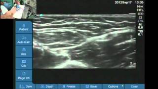 How to find nerves for axillary block [upl. by Maclay]