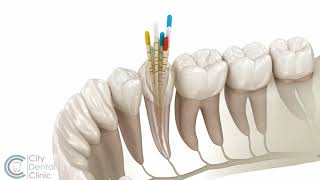 Endodontie  Wurzelbehandlung  City Dental Clinic Bratislava [upl. by Eenat]