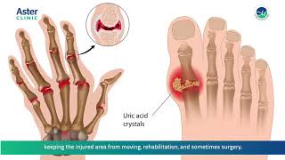 Dr Harshvardhan talks about Joint Disorders [upl. by Willi]