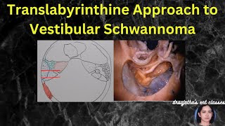 244 Translabrynthine Approach to Vestibular Schwannoma surgeryeducation [upl. by Runkle]