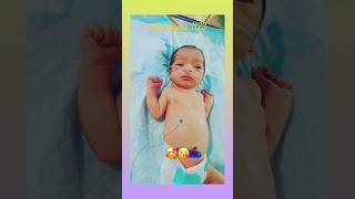 tracheoesophageal fistulanicu nicubaby viralvideo shorts 😍😍🥰🥰😘😘😘 [upl. by Rotciv]