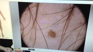 microfinder  microderm dermoscopy  diagnosis [upl. by Animehliw]