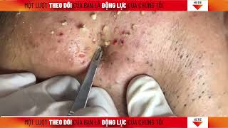 EP12 NẶN MỤN ĐẦU ĐEN amp CHIA SẺ VỀ TƯ SĨ THÍCH MINH TUỆ blackhead removal Nặn Mụn [upl. by Eldnik]