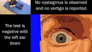 Animated Rotary Nystagmus During a Claymation DixHallpike Test for BPPV [upl. by Arikal]