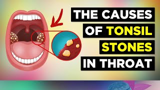 The REAL Cause of Tonsil Stones and Treatment [upl. by Dnalloh]