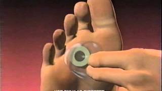 Dr Scholls Commercial 1996 Callus Removers Cushlin Advanced Pain Relief [upl. by Hannad]