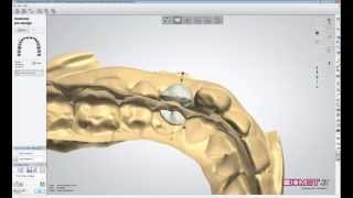 2013 3Shape Screw Retained Implant Crown Demo [upl. by Rosenzweig]