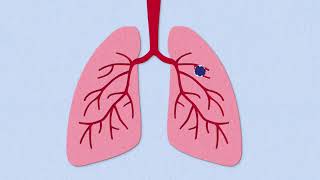 Cystic Fibrosis  MedicalSurgical  Respiratory System  LevelUpRN [upl. by Eldwen]