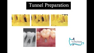 TUNNEL PREPARATIONTREATMENT OF FURCATION INVOLVEMENTDR ANKITA KOTECHADENTAL STUDIES SIMPLIFIED [upl. by Nevarc268]