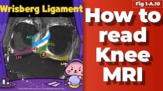 Fig 1A10 Meniscofemoral ligament Wrisberg ligament [upl. by Eened]