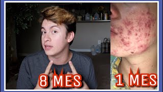 TERMINE MI TRATAMIENTO TREVISSAGE  ADIOS ACNE — Heeysoycesar [upl. by Jack]