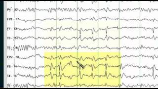 Focal EEG Abnormalities 1 [upl. by Issirk]