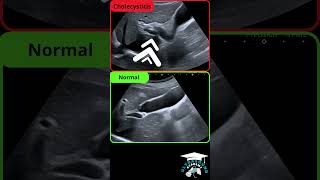 Incipient Cholecystitis Ultrasound Findings [upl. by Assyn885]