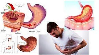 What is a gastritis causes of gastritis gestritis Animation 3d video gastritis  cardiac tech [upl. by Rufford]