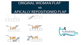 ORIGINAL WIDMAN FLAP vs APICALLY REPOSITIONED FLAP PERIODONTAL FLAP SURGERY DR ANKITA KOTECHA [upl. by Atsejam]