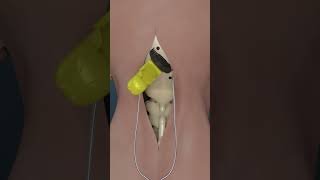 How Brain Clot Is Removed 3D Animation shorts [upl. by Arihsan]