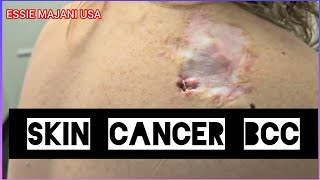 Skin Cancer misdiagnosed Basal Cell Carcinoma 😞😢 [upl. by Saphra]